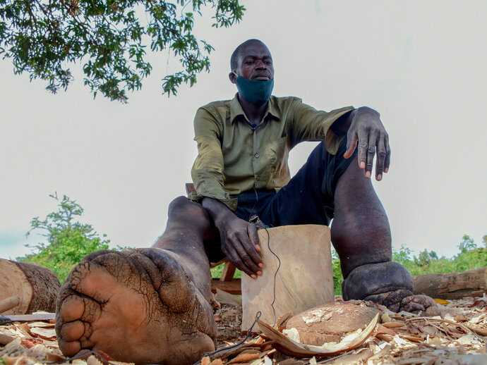 A man sits doing woodworking, his leg extended out front which shows that he has lymphedema in his right leg. 