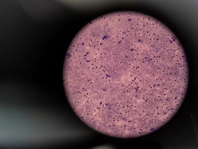 Lab technicians in Indonesia analyze night blood survey samples like this one, as seen in a microscope, to determine if lymphatic filariasis worms are present. Photo Credit: RTI International/Oscar Siagian