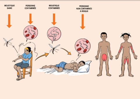 Excerpt from Image Box on lymphatic filariasis.