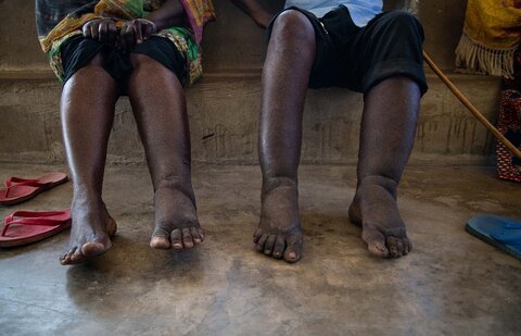 Two patients visit a health center for care for elephantiasis caused by lymphatic filariasis. Photo Credit: RTI International/Roshni Lodhia 